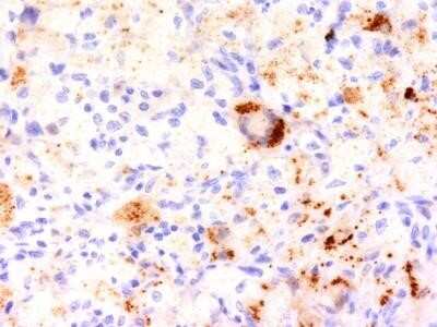Immunohistochemistry-Paraffin: TNF-alpha Antibody (TNF706) - Azide and BSA Free [NBP2-34728] - Formalin-fixed, paraffin-embedded human Erdheim Chester disease (also known as polyostotic scsclerosing histiocytosis) stained with TNF alpha Monoclonal Antibody (TNF706).