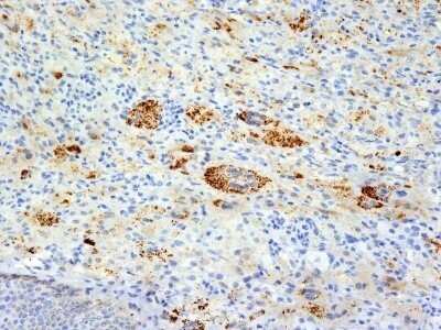 Immunohistochemistry-Paraffin: TNF-alpha Antibody (TNFA/1172) - Azide and BSA Free [NBP2-47675] - Human Erdheim Chester disease (also known as polyostotic lerosing histiocytosis) stained with TNF alpha Monoclonal Antibody (TNFA/1172).