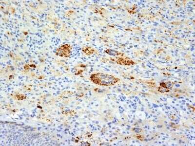 Immunohistochemistry-Paraffin: TNF-alpha Antibody (TNFA/1172) [NBP2-45331] - Human Erdheim Chester disease (also known as polyostotic lerosing histiocytosis) stained with TNF alpha Monoclonal Antibody (TNFA/1172).