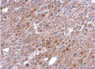 Immunohistochemistry-Paraffin: TNFAIP2 Antibody [NBP1-33480] - Paraffin-embedded HeLa xenograft.  TNFalpha-IP 2 antibody [C1C3]  dilution: 1:500.