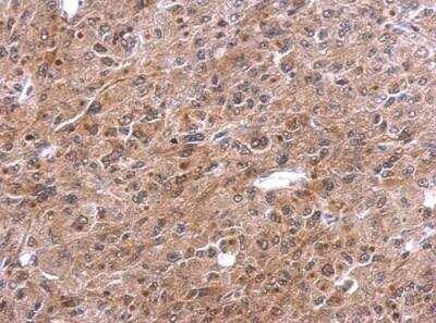 Immunohistochemistry-Paraffin: TNFAIP2 Antibody [NBP1-33480] - Paraffin-embedded HeLa xenograft. TNFalpha-IP 2 antibody [C1C3] dilution: 1:500.