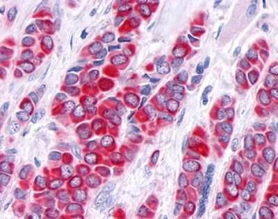 Immunohistochemistry-Paraffin: TNIK Antibody [NLS7401] - Analysis of anti-TNIK antibody with human breast, carcinoma.