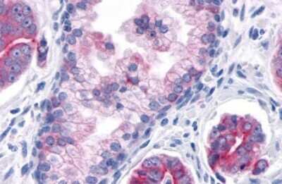 Immunohistochemistry-Paraffin: TNIK Antibody [NLS7401] - Anti-TNIK antibody IHC of human Prostate, Carcinoma. Immunohistochemistry of formalin-fixed, paraffin-embedded tissue after heat-induced antigen retrieval.