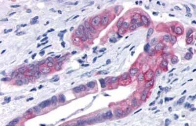 Immunohistochemistry-Paraffin: TNIK Antibody [NLS7401] - Anti-TNIK antibody IHC of human Pancreas, Carcinoma. Immunohistochemistry of formalin-fixed, paraffin-embedded tissue after heat-induced antigen retrieval.