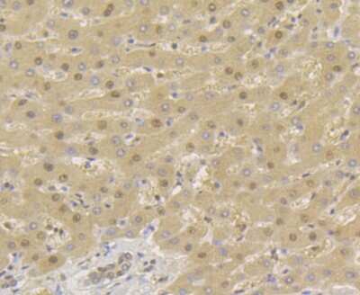 Immunohistochemistry-Paraffin: TNPO3 Antibody (JG38-77) [NBP2-75685] - Analysis of paraffin-embedded human liver cancer tissue using anti-TNPO3 antibody. Counter stained with hematoxylin.