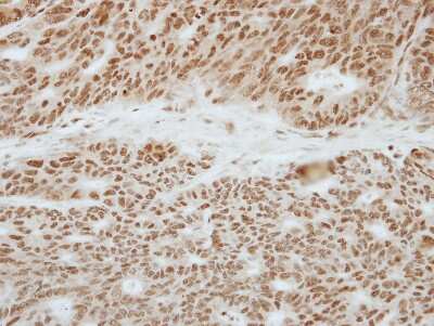 Immunohistochemistry-Paraffin: TOE1 Antibody [NBP2-20678] - Immunohistochemical analysis of paraffin-embedded Colon ca, using antibody at 1:250 dilution.
