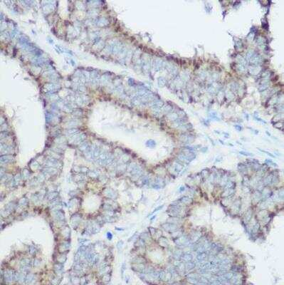 Immunohistochemistry-Paraffin: TOMM20 Antibody [NBP2-94821] -  Human colon carcinoma using [KO Validated] TOM20 Rabbit pAb at dilution of 1:100 (40x lens).Perform high pressure antigen retrieval with 10 mM citrate buffer pH 6.0 before commencing with IHC staining protocol.