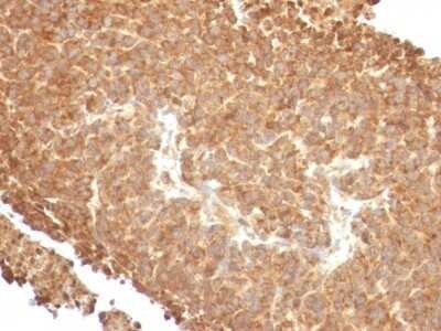 Immunohistochemistry-Paraffin: TOP1MT Antibody (TOP1MT/488) - Azide and BSA Free [NBP2-47793] - Human Melanoma stained with Topo I, MT Monoclonal Antibody (TOP1MT/488).