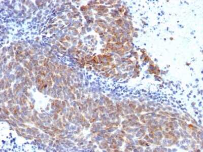 Immunohistochemistry-Paraffin: TOP1MT Antibody (TOP1MT/568) - Azide and BSA Free [NBP3-08305] - Formalin-fixed, paraffin-embedded human Melanoma stained with TOP1MT Mouse Monoclonal Antibody (TOP1MT/568).