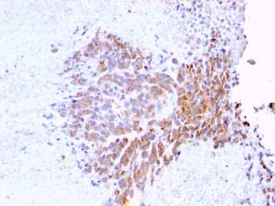 Immunohistochemistry-Paraffin: TOP1MT Antibody (TOP1MT/568) - Azide and BSA Free [NBP3-08305] - Formalin-fixed, paraffin-embedded human Melanoma stained with TOP1MT Mouse Monoclonal Antibody (TOP1MT/568)