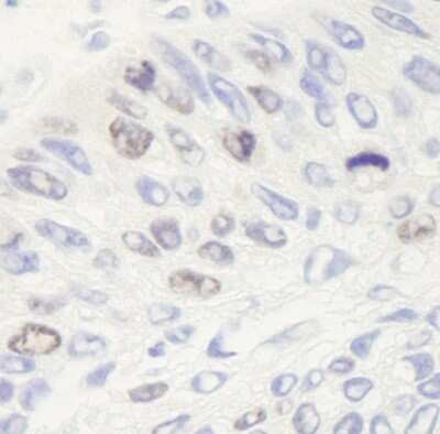 Immunohistochemistry: TOP2A Antibody [NB110-40636] - Sample: FFPE section of human larynx squamous cell carcinoma. Antibody: Affinity purified rabbit anti-Topo II Alpha used at a dilution of 1:250. Detection: DAB staining using anti-Rabbit IHC antibody at a dilution of 1:100.