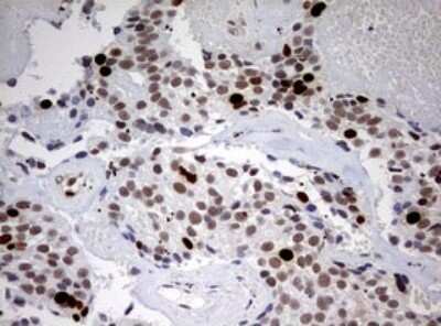 Immunohistochemistry: TOP2A Antibody (OTI2A9) - Azide and BSA Free [NBP2-74558] - Analysis of Adenocarcinoma of Human breast tissue. (Heat-induced epitope retrieval by 10mM citric buffer, pH6.0, 120C for 3min)