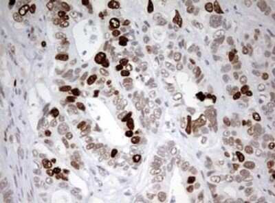 Immunohistochemistry: TOP2A Antibody (OTI2A9) - Azide and BSA Free [NBP2-74558] - Analysis of Adenocarcinoma of Human colon tissue. (Heat-induced epitope retrieval by 10mM citric buffer, pH6.0, 120C for 3min)