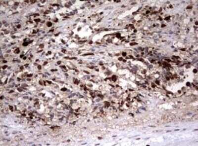 Immunohistochemistry: TOP2A Antibody (OTI2A9) - Azide and BSA Free [NBP2-74558] - Analysis of Adenocarcinoma of Human endometrium tissue. (Heat-induced epitope retrieval by 10mM citric buffer, pH6.0, 120C for 3min)