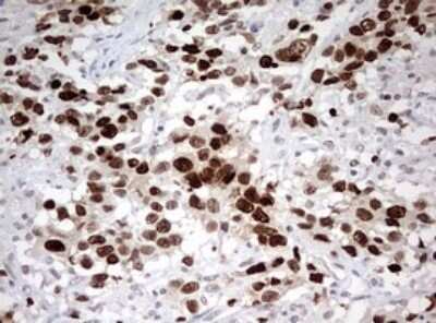 Immunohistochemistry: TOP2A Antibody (OTI2A9) - Azide and BSA Free [NBP2-74558] - Analysis of Adenocarcinoma of Human ovary tissue. (Heat-induced epitope retrieval by 10mM citric buffer, pH6.0, 120C for 3min)