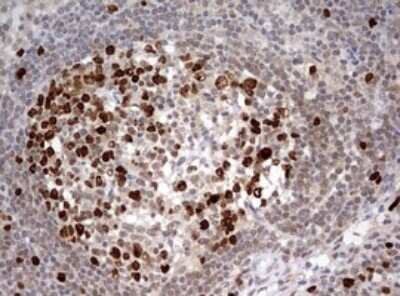 Immunohistochemistry: TOP2A Antibody (OTI2A9) - Azide and BSA Free [NBP2-74558] - Analysis of Carcinoma of Human bladder tissue. (Heat-induced epitope retrieval by 10mM citric buffer, pH6.0, 120C for 3min)