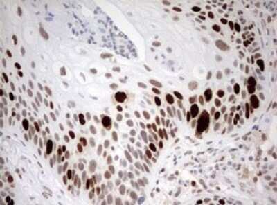 Immunohistochemistry: TOP2A Antibody (OTI2A9) - Azide and BSA Free [NBP2-74558] - Analysis of Carcinoma of Human lung tissue. (Heat-induced epitope retrieval by 10mM citric buffer, pH6.0, 120C for 3min)