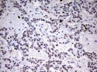 Immunohistochemistry: TOP2A Antibody (OTI2A9) - Azide and BSA Free [NBP2-74558] - Analysis of Carcinoma of Human pancreas tissue. (Heat-induced epitope retrieval by 10mM citric buffer, pH6.0, 120C for 3min)