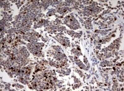 Immunohistochemistry: TOP2A Antibody (OTI2A9) - Azide and BSA Free [NBP2-74558] - Analysis of Human lymphoma tissue. (Heat-induced epitope retrieval by 10mM citric buffer, pH6.0, 120C for 3min)