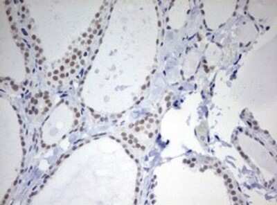 Immunohistochemistry: TOP2A Antibody (OTI2A9) - Azide and BSA Free [NBP2-74558] - Analysis of Human thyroid tissue. (Heat-induced epitope retrieval by 10mM citric buffer, pH6.0, 120C for 3min)