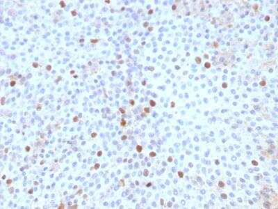 Immunohistochemistry-Paraffin: TOP2A Antibody (TOP2A/1361) [NBP2-47643] - Formalin-fixed, paraffin-embedded Human Bladder Carcinoma stained with Topoisomerase II alpha Monoclonal Antibody (TOP2A/1361).  