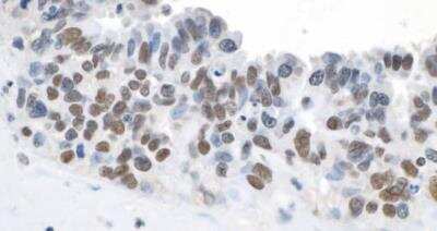 Immunohistochemistry-Paraffin: TOP2B Antibody [NB100-40842] - Sample: FFPE section of human ovarian cancer. Antibody: Affinity purified rabbit anti-Topo II Beta used at a dilution of 1:1,000 (0.2ug/ml). Detection: DAB