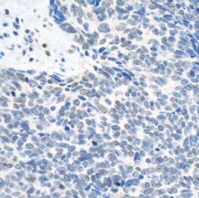 Immunohistochemistry-Paraffin: TOP2B Antibody [NB100-40842] - FFPE section of human small cell lung cancer. Antibody: Affinity purified rabbitanti-Topo II Beta used at a dilution of 1:1,000 (0.2ug/ml). Detection: DAB