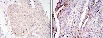 Immunohistochemistry-Paraffin: TORC2 Antibody (5B10) [NBP1-51665] - Immunohistochemical analysis of paraffin-embedded ovary tumour tissues (left) and lung cancer (right) using CRTC2 mouse mAb with DAB staining.