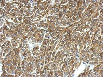 Immunohistochemistry-Paraffin: TPD52 Antibody [NBP2-20686] - Immunohistochemical analysis of paraffin-embedded HBL435 xenograft, using antibody at 1:500 dilution.