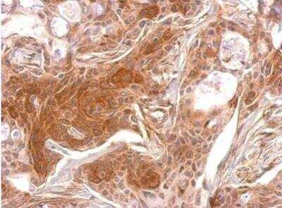 Immunohistochemistry-Paraffin: TPK1 Antibody [NBP1-32248] - Paraffin-embedded Cal27 xenograft.  TPK1 antibody dilution: 1:500.