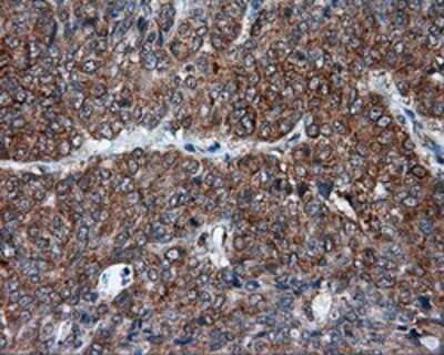 Immunohistochemistry-Paraffin: TPMT Antibody (2A2) [NBP2-02356] - Staining of paraffin-embedded Adenocarcinoma of endometrium tissue using anti-TPMT mouse monoclonal antibody.