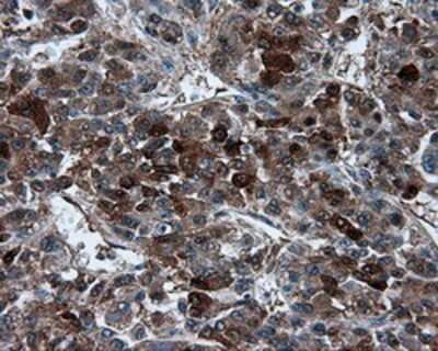 Immunohistochemistry-Paraffin: TPMT Antibody (2A2) [NBP2-02356] - Staining of paraffin-embedded Carcinoma of liver tissue using anti-TPMT mouse monoclonal antibody.