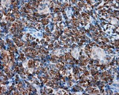 Immunohistochemistry-Paraffin: TPMT Antibody (2A2) [NBP2-02356] - Staining of paraffin-embedded Carcinoma of thyroid tissue using anti-TPMT mouse monoclonal antibody.