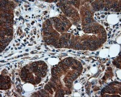 Immunohistochemistry: TPMT Antibody (OTI2A2) - Azide and BSA Free [NBP2-74570] - Staining of paraffin-embedded Adenocarcinoma of colon tissue using anti-TPMT mouse monoclonal antibody.