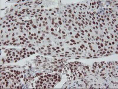 Immunohistochemistry-Paraffin: TPRKB Antibody (3H3) [NBP2-03885] - Staining of paraffin-embedded Carcinoma of Human bladder tissue using anti-TPRKB mouse monoclonal antibody.