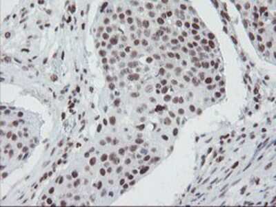 Immunohistochemistry-Paraffin: TPRKB Antibody (3H3) [NBP2-03885] - Staining of paraffin-embedded Carcinoma of Human lung tissue using anti-TPRKB mouse monoclonal antibody.