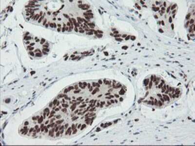 Immunohistochemistry-Paraffin: TPRKB Antibody (3H3) [NBP2-03885] - Staining of paraffin-embedded Carcinoma of Human pancreas tissue using anti-TPRKB mouse monoclonal antibody.