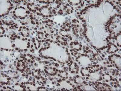 Immunohistochemistry-Paraffin: TPRKB Antibody (3H3) [NBP2-03885] - Staining of paraffin-embedded Carcinoma of Human thyroid tissue using anti-TPRKB mouse monoclonal antibody.