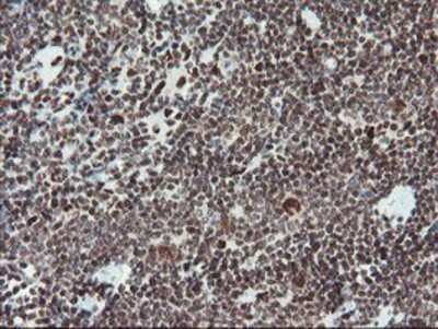 Immunohistochemistry-Paraffin: TPRKB Antibody (3H3) [NBP2-03885] - Staining of paraffin-embedded Human lymphoma tissue using anti-TPRKB mouse monoclonal antibody.