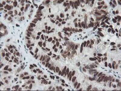 Immunohistochemistry: TPRKB Antibody (OTI3H3) - Azide and BSA Free [NBP2-74574] - Staining of paraffin-embedded Adenocarcinoma of Human ovary tissue using anti-TPRKB mouse monoclonal antibody.