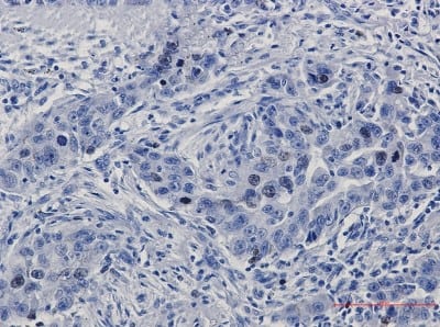 Immunohistochemistry-Paraffin: TPX2 Antibody (S01-8A6) [NBP3-19922] - Immunohistochemistry of TPX2 in paraffin-embedded Human lung cancer tissue using NBP3-19922 at dilution 1/50