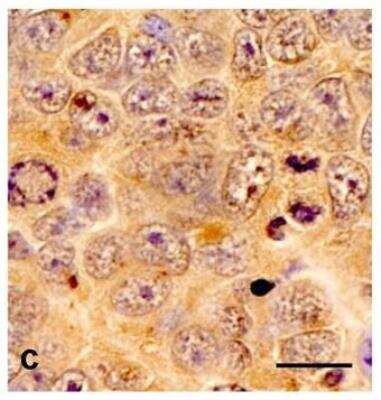 Immunohistochemistry: TPX2 Antibody (TPX2-01) [NBP2-67265] - TPX2 in U87MG human glioblastoma cells (orthotopic xenograft in murine brain). Bar: 20 um.