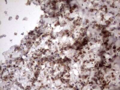 Immunohistochemistry: TR2/NR2C1 Antibody (4C7) [NBP2-46227] - Analysis of Adenocarcinoma of Human breast tissue.