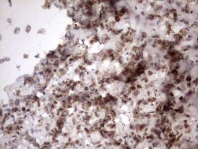 Immunohistochemistry: TR2/NR2C1 Antibody (OTI4C7) - Azide and BSA Free [NBP2-74576] - Analysis of Adenocarcinoma of Human breast tissue.