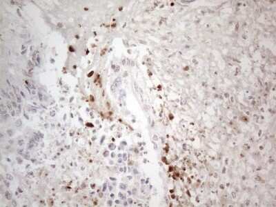 Immunohistochemistry: TR4/NR2C2 Antibody (4B1) [NBP2-46228] - Analysis of Adenocarcinoma of Human colon tissue. (Heat-induced epitope retrieval by 1mM EDTA in 10mM Tris buffer (pH8.5) at 120C for 3 min)