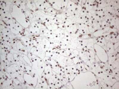 Immunohistochemistry: TR4/NR2C2 Antibody (4B1) [NBP2-46228] - Analysis of Carcinoma of Human kidney tissue. (Heat-induced epitope retrieval by 1mM EDTA in 10mM Tris buffer (pH8.5) at 120C for 3 min)