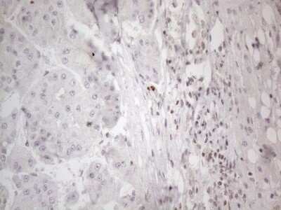 Immunohistochemistry: TR4/NR2C2 Antibody (4B1) [NBP2-46228] - Analysis of Carcinoma of Human liver tissue.(Heat-induced epitope retrieval by 1mM EDTA in 10mM Tris buffer (pH8.5) at 120C for 3 min)