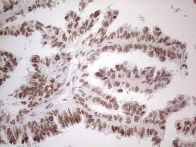 Immunohistochemistry: TR4/NR2C2 Antibody (4B1) [NBP2-46228] - Analysis of Adenocarcinoma of Human ovary tissue. (Heat-induced epitope retrieval by 1mM EDTA in 10mM Tris buffer (pH8.5) at 120C for 3 min)