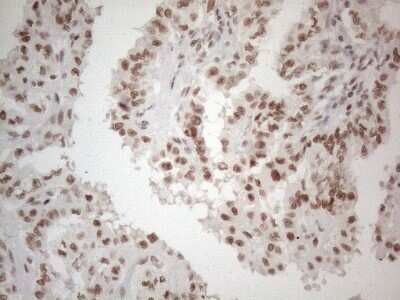 Immunohistochemistry: TR4/NR2C2 Antibody (4B1) [NBP2-46228] - Analysis of Carcinoma of Human thyroid tissue. (Heat-induced epitope retrieval by 1mM EDTA in 10mM Tris buffer (pH8.5) at 120C for 3 min)