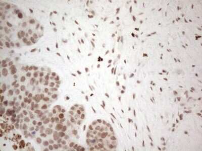 Immunohistochemistry: TR4/NR2C2 Antibody (4B1) [NBP2-46228] - Analysis of Adenocarcinoma of Human endometrium tissue. (Heat-induced epitope retrieval by 1mM EDTA in 10mM Tris buffer (pH8.5) at 120C for 3 min)